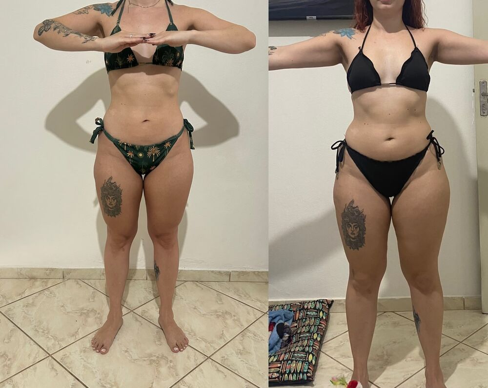 Redução de medidas e modelagem corporal — antes e depois, vista de frente, paciente da Gleice.