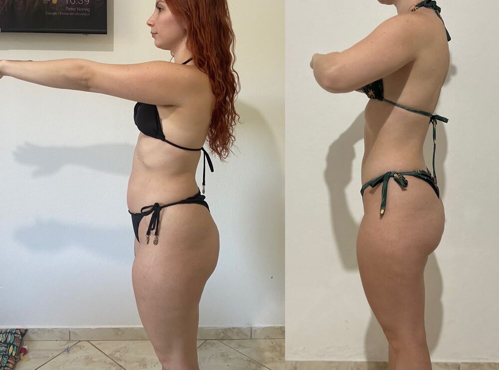 Redução de medidas e modelagem corporal — antes e depois, vista de perfil, paciente da Gleice.