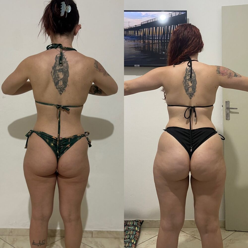 Redução de medidas e modelagem corporal — antes e depois, vista de costas, paciente da Gleice.
