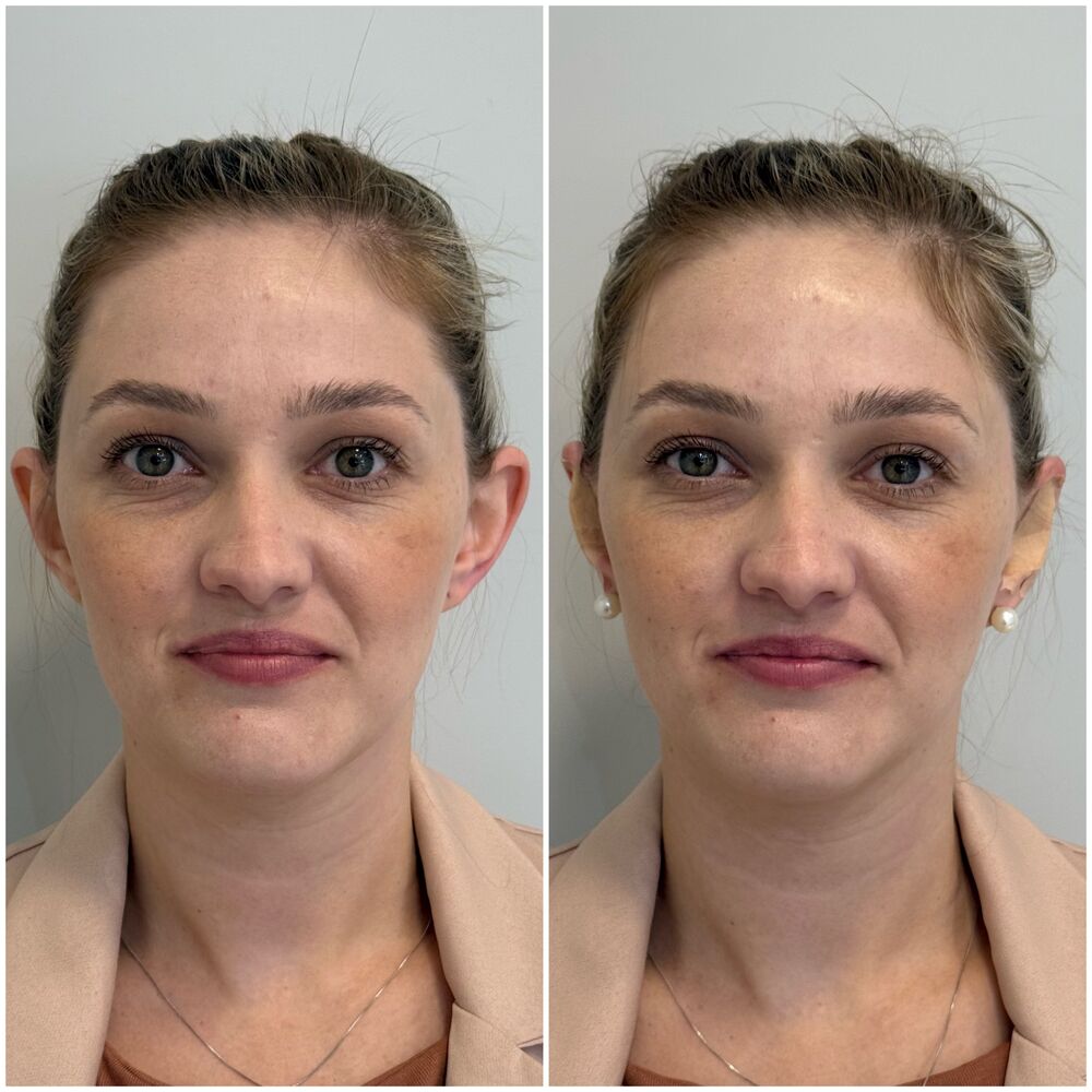 Otomodelação — antes e depois, vista frontal de paciente.
