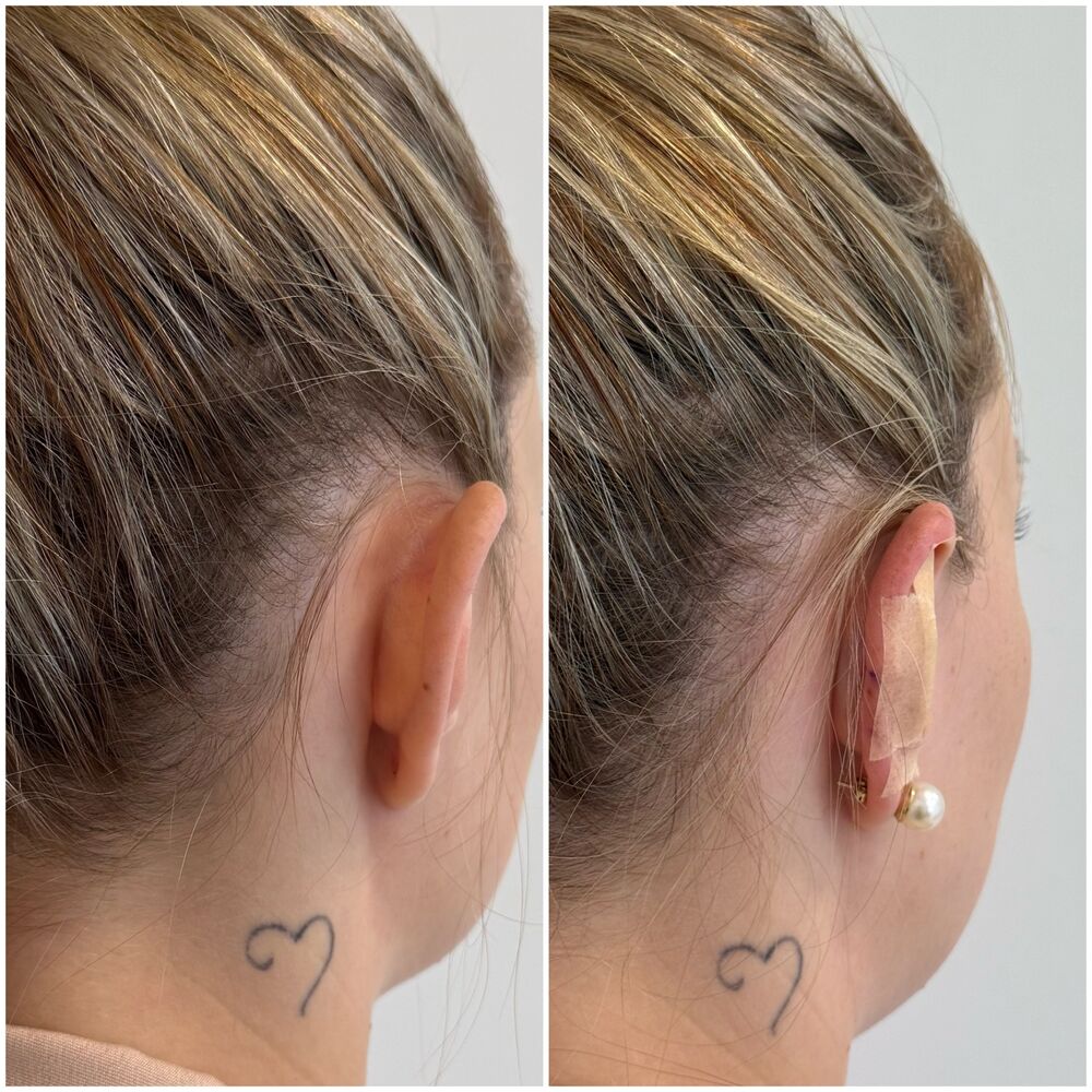 Otomodelação — perfil lateral antes e depois, mostrando a orelha reposicionada com curativo de manutenção.