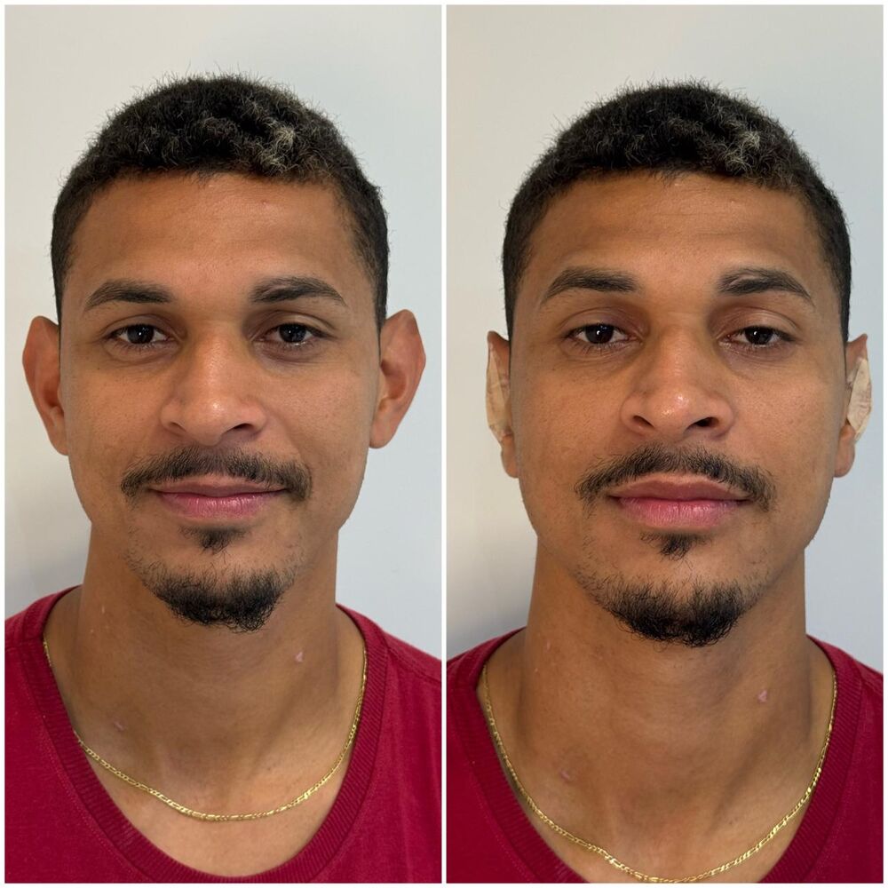 Otomodelação — antes e depois, vista frontal de paciente.