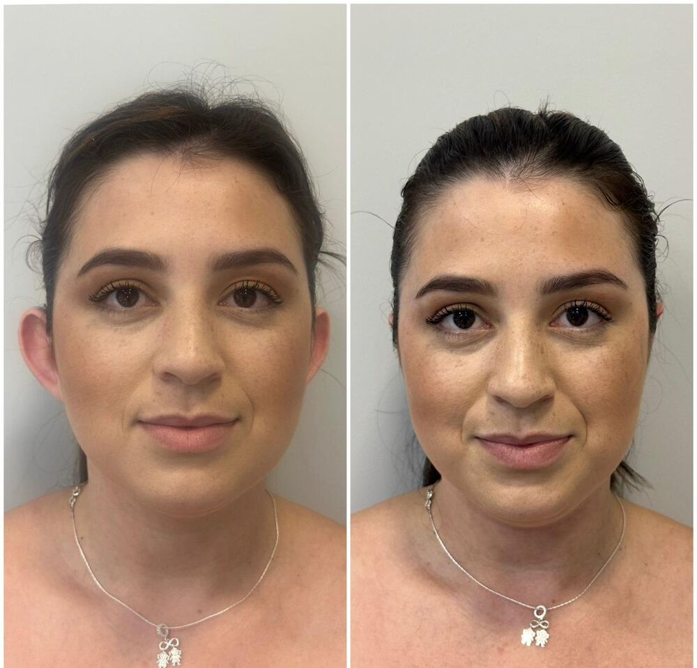 Otomodelação — antes e depois, vista frontal de paciente.